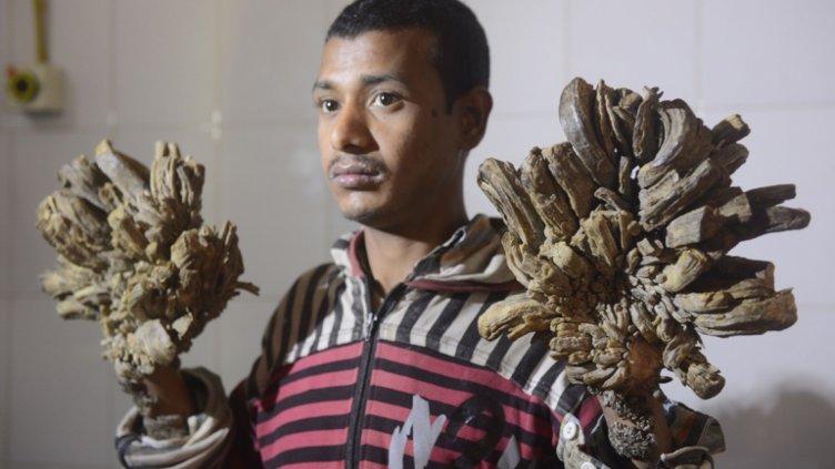 Оперираха успешно човека-дърво