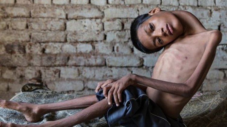 Махендра Ахуруар преди операцията