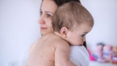 РЗИ – Варна: Защитете децата си от морбили и рубеола