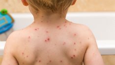 Расте броят на заболелите от варицела и скарлатина във Варненско