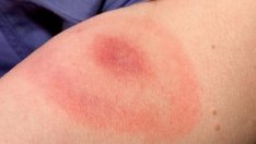 Кърлежи няма, но варненец пипна Лаймска болест