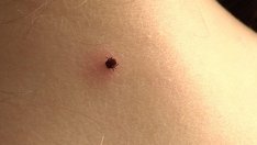 Кърлежите във Варна се активизираха