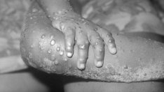 Засякоха два различни щама на маймунска шарка