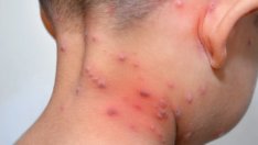 Огромен ръст на болните от шарки във Варна