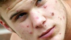 Маймунската шарка вече шари в 29 страни. Най-много има във Великобритания