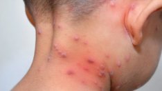 Значителен ръст на заболелите от шарки във Варненско