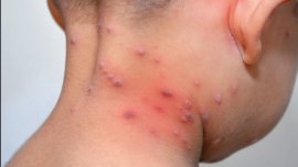 Ръст на шарките във Варна и спад на заболелите от COVID