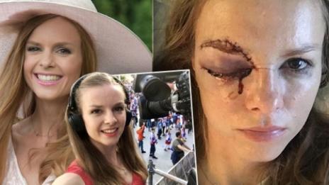  Удар с хокейна шайба прати в болницата словашка журналистка