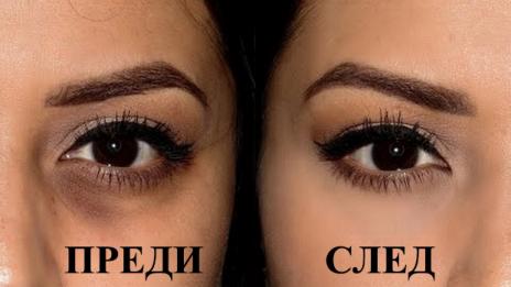 Как да се преборим с тъмните кръгове под очите?