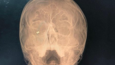 Стрелба пред клуб в София: Студент е бил прострелян в главата с въздушна пушка