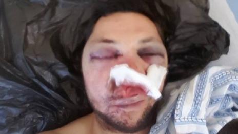 Война в Поморие: Кметът срещу пребития журналист