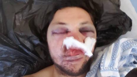 Двама пребиха журналист в Поморие (16+)