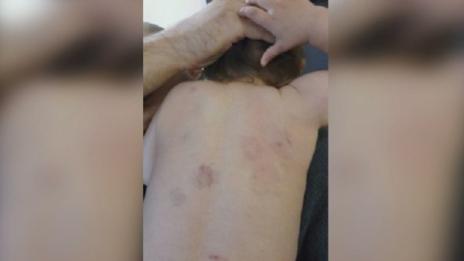 Дете с жестоки ухапвания в ясла. Директорката: Не са били сами!