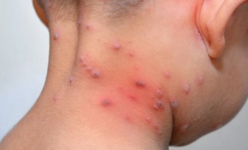 Ръст на шарките във Варна и спад на заболелите от COVID