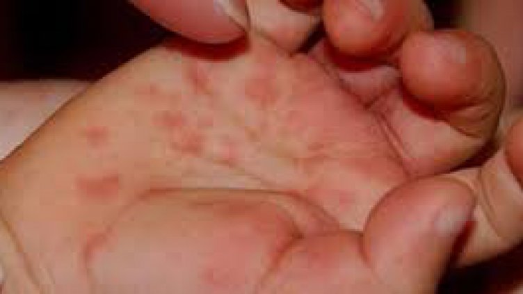 Всеки 10-и страда от студова алергия