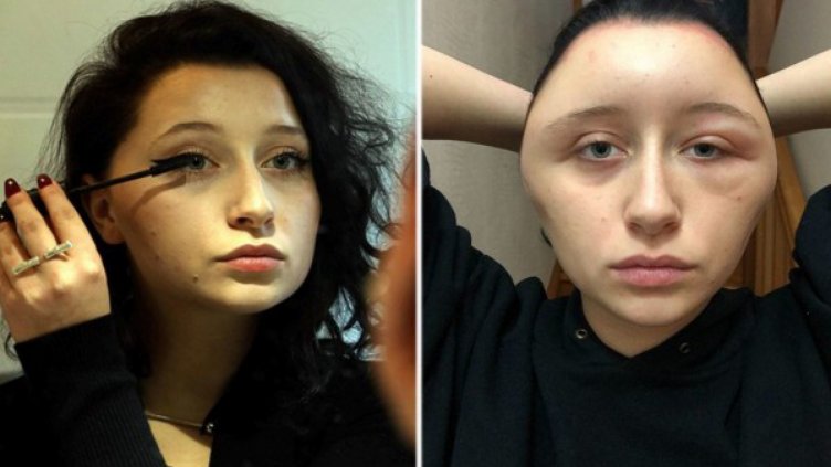 Жертва на суетата: Млада жена с алергична реакция към боя