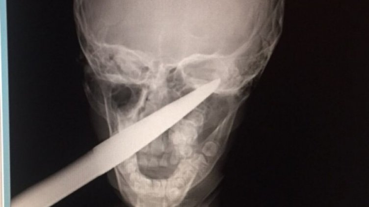 Лекари спасиха 7-годишно дете със забита градинска ножица в главата