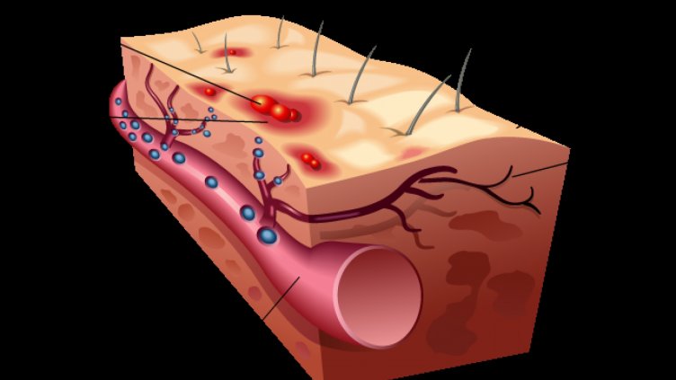 Херпес зостер - как ни заразява
