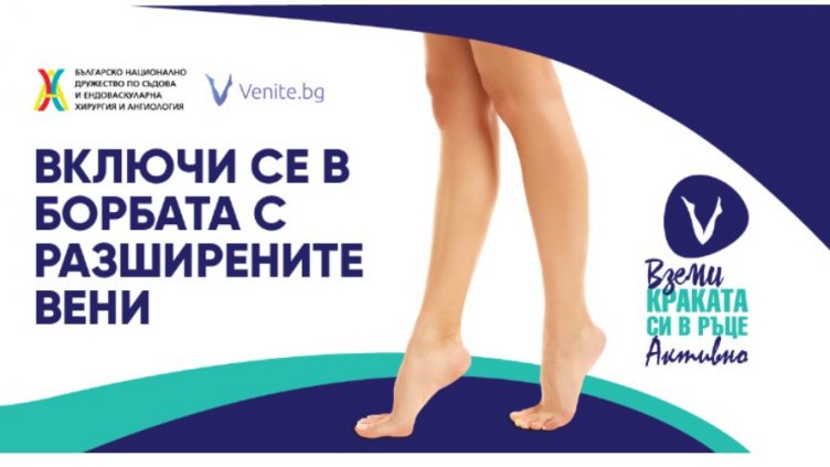 Преглеждат безплатно за разширени вени във Варна