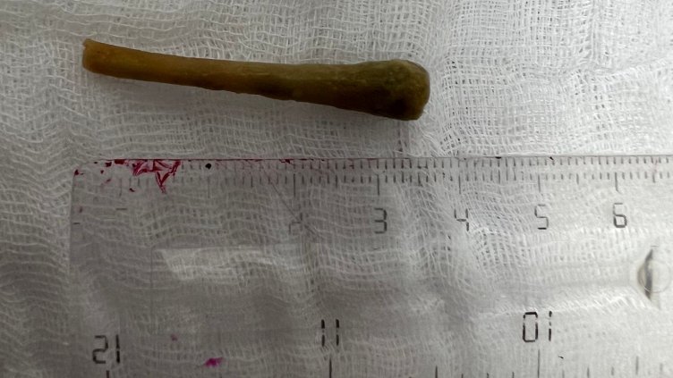 Лекували мъж 4 месеца от пневмония, оказало се кост от пиле (СНИМКИ/ВИДЕО)