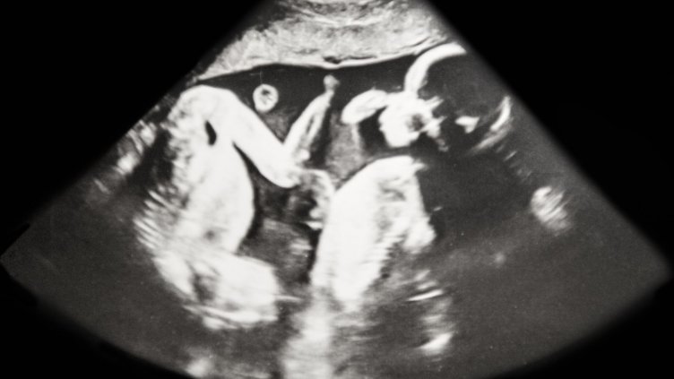 Феномен: Жена с две матки роди две бебета - по едно във всяка от тях