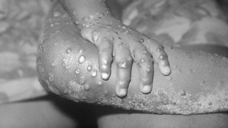 Ръкостискане, целувки, секс... За какво да гледаме при маймунска шарка?