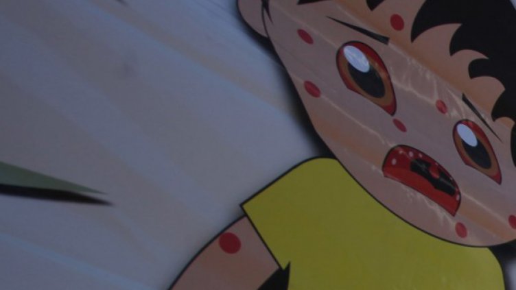 Болните от морбили станаха 11, но пък няма нови огнища