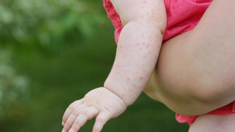 Дете от Варна се разболя от морбили