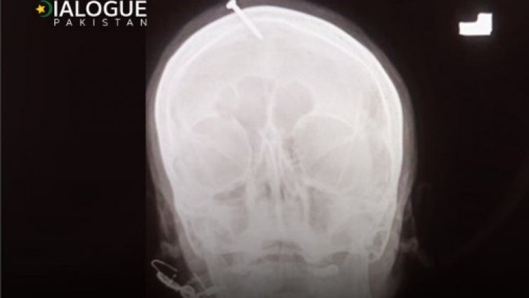 По съвет на врачка: Бременна заби пирон в главата си, за да роди момче!