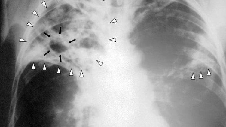 Преглеждат безплатно за туберкулоза във Варна