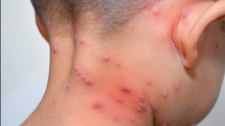 Регистрираха първия случай на дете с маймунска шарка