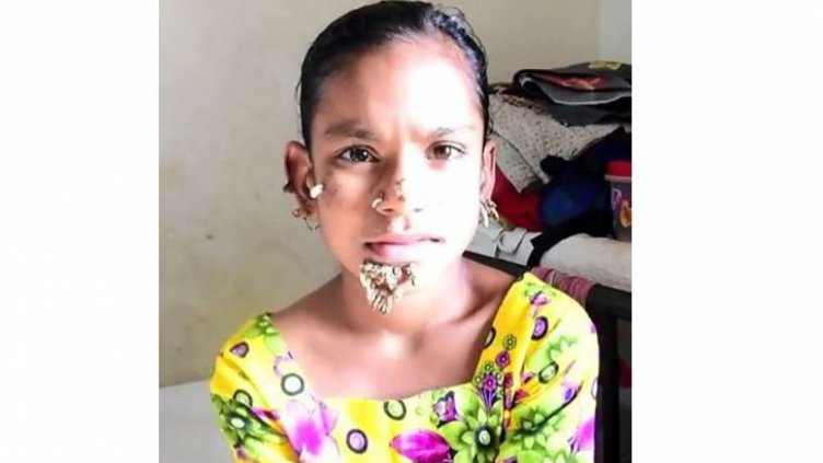 Момиче може би е първата жена-дърво в света