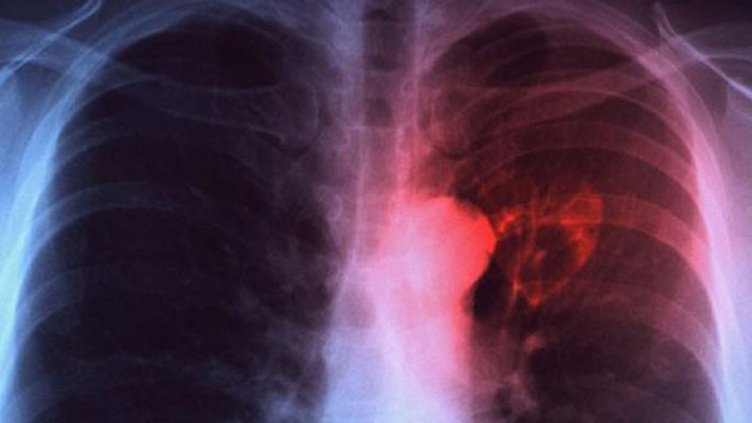 Тревога в "Ботунец" – дете се разболя от туберкулоза