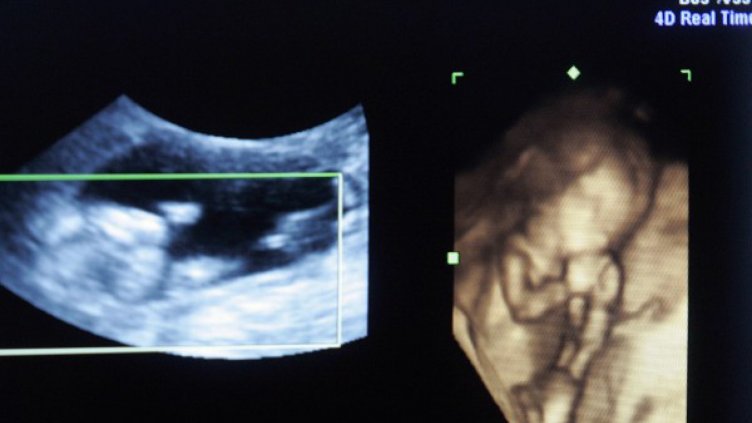 Спасиха с уникална операция бебе в 15-а седмица