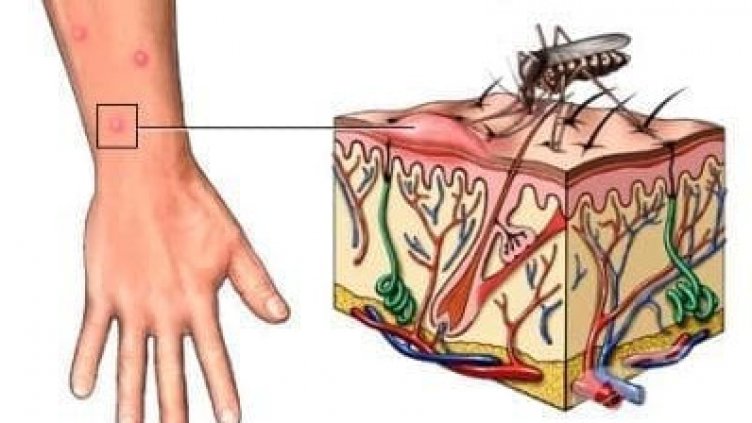 Денга се смърт в Аржентина