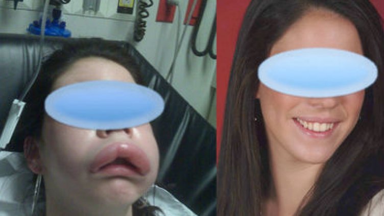 Насекомо вкара варненка в болница