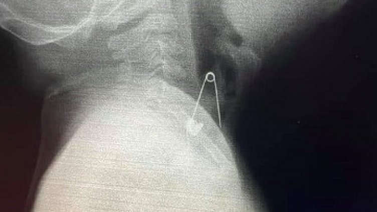 Извадиха безопасна игла от гърлото на 6-месечно бебе във Варна