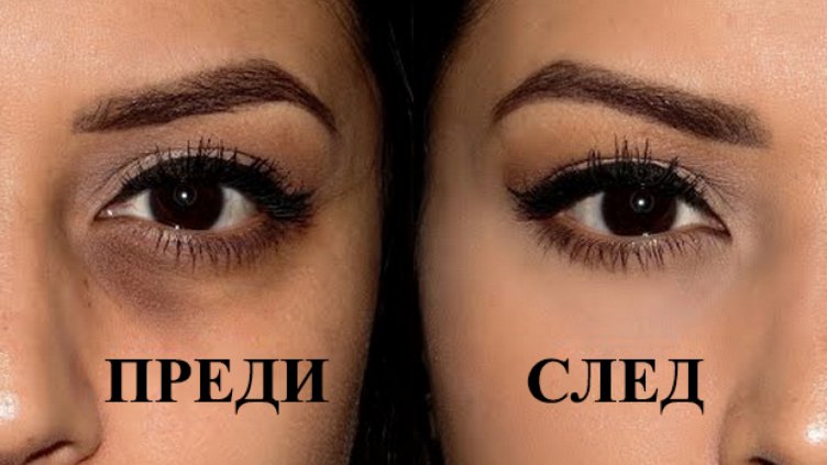 Как да се преборим с тъмните кръгове под очите?