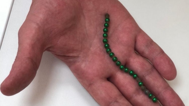 Вадиха с операция магнитни топчета от стомаха на 6-годишна