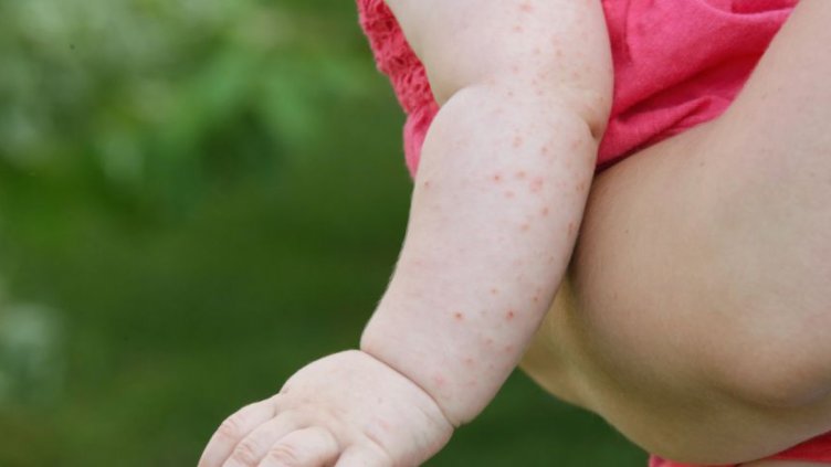 Расте броят на болните от морбили в Благоевград