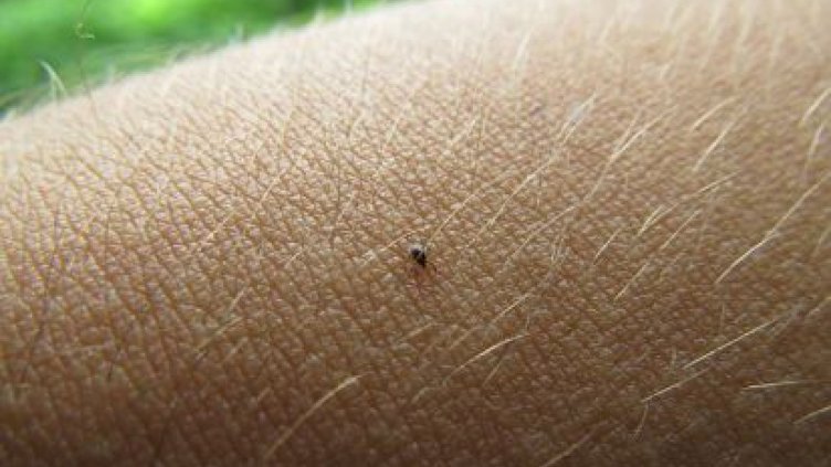 Регистрираха случай на лаймска болест във Варна