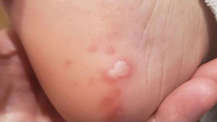 Родни медици откриха нов К-19 симптом, имат го 20% от заразените