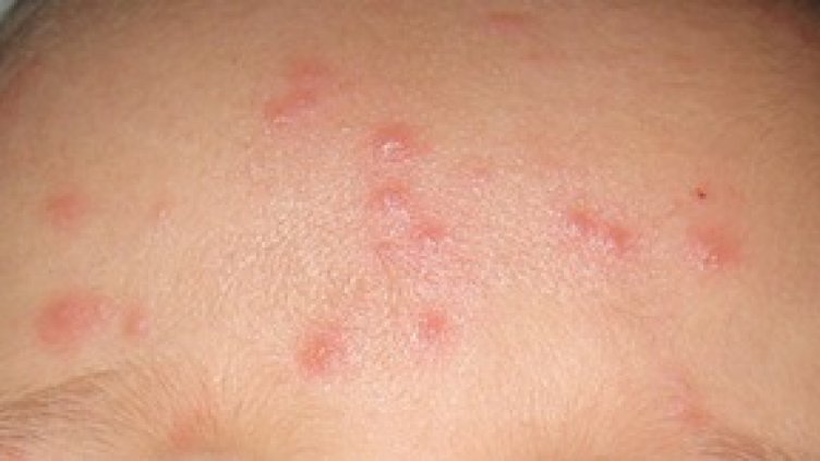 Варицела и скарлатина плъзнаха по забавачките