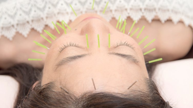 Козметична акупунктура: Какво представлява?	