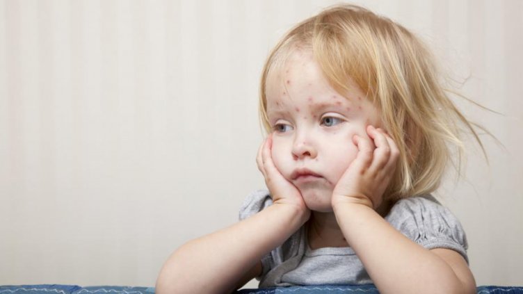 Расте броят на болните от варицела и скарлатина във Варненско