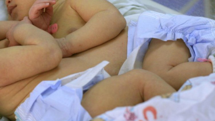 Майката на сиамските близнаци... липсва! Борят се за живота им