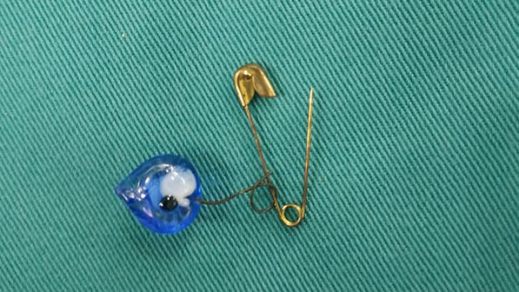 Изписха бебето, погълнало безопасна игла