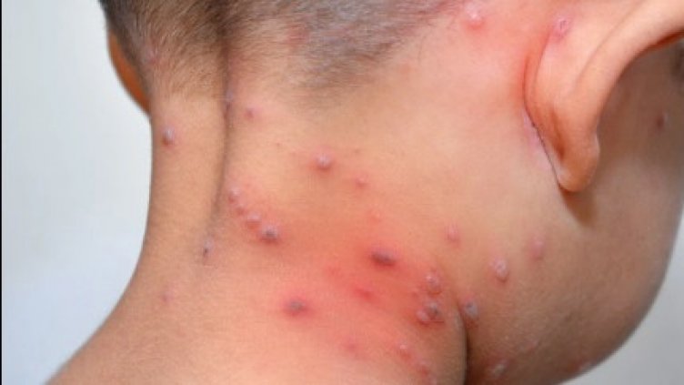 Варненските градини пламнаха от шарка