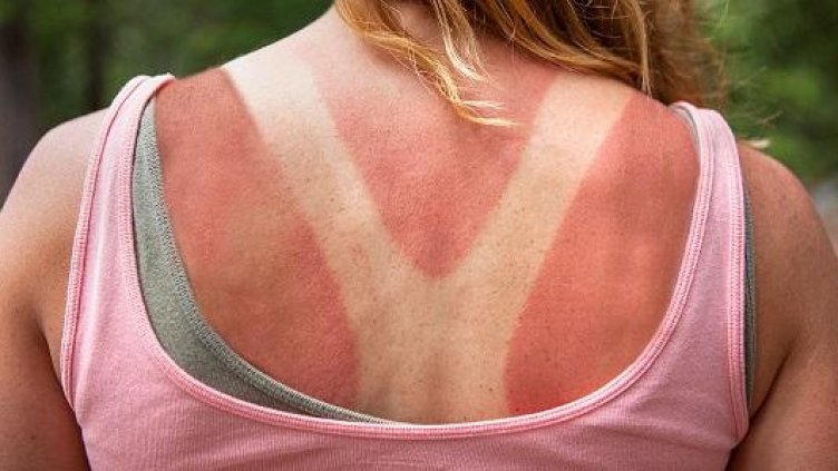 Изгорял си на припек? Какво да ядете, пиете, как и кожата да третирате?