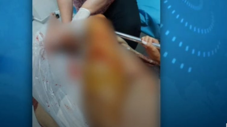 Изверг обезобрази 18-годишна: Рязал момичето с макетно ножче, счупил й носа и я обръснал